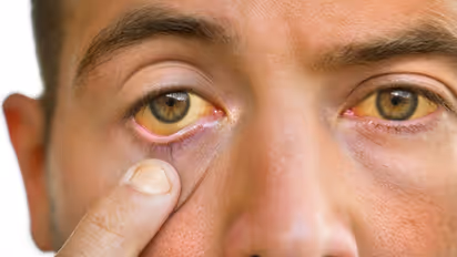 पीलिया से बचाव के उपाय: जानें क्या खाना चाहिए और क्या नहीं...