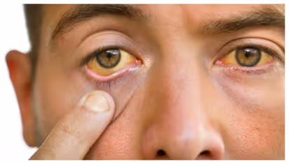 Kerala: Jaundice cases surge in Ernakulam; 722 cases, 8 deaths reported in 2024 as health dept urges caution