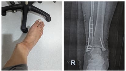 ഇന്‍ഡിഗോയുടെ റാമ്പ് ഉപയോഗിക്കവെ തകര്‍ന്ന് പോയ തന്‍റെ കാലിന്‍റെ അനുഭവം പങ്കുവച്ച് യുവാവ്; കുറിപ്പ് വൈറൽ 