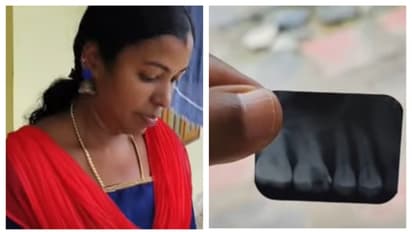 റൂട്ട് കനാൽ ചെയ്ത പല്ലിൽ സൂചി ഒടിഞ്ഞിരിക്കുന്നു, നെടുമങ്ങാട് ജില്ല ആശുപത്രിയിൽ ചികിത്സ പിഴവെന്ന് പരാതി