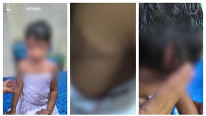 കൊല്ലത്ത് മുത്തച്ഛനൊപ്പം നടന്നു പോയ 3 വയസുകാരിയെ തെരുവുനായ ആക്രമിച്ചു; തലക്കും കൈകൾക്കും പരിക്ക്