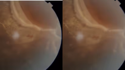 പാർക്കിങ്ങിൽ ക്രിക്കറ്റ് കളിക്കുന്നതിനിടെ പന്ത് കൊണ്ടത് ഇടതുകണ്ണിൽ; റെറ്റിനയിൽ വിടവ്, അടിയന്തര ചികിത്സ തുണയായി