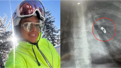 വിട്ടുമാറാത്ത ജലദോഷം, പനി, വിറയൽ; ന്യൂമോണിയയെന്ന് കരുതി, പക്ഷേ എക്സ് റേയിൽ കണ്ടെത്തിയത് മറ്റൊന്ന്- സംഭവമിങ്ങനെ