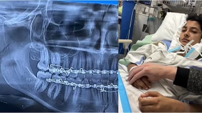 ഷോപ്പിംഗിനിടെ 'ഫേമസ്' മിഠായി ഒന്ന് പരീക്ഷിച്ചു, 19കാരിയുടെ താടിയെല്ല് പൊട്ടി, പല്ലുകൾ ഇളകിയ നിലയിൽ