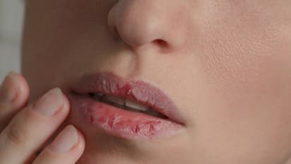 Health Tips: മഞ്ഞുകാലത്ത് ചുണ്ടുകള് വരണ്ടുപൊട്ടുന്നത് തടയാന് ചെയ്യേണ്ട കാര്യങ്ങള്