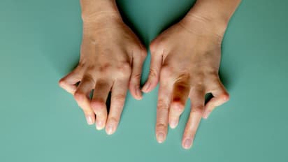 റൂമറ്റോയ്ഡ് ആർത്രൈറ്റിസ്; ശരീരം സൂചിപ്പിക്കുന്ന അഞ്ച് ലക്ഷണങ്ങള്