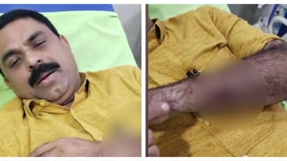 അവിശ്വാസ പ്രമേയത്തെ അനുകൂലിച്ച് വോട്ട് ചെയ്തു; പനമരത്ത് വാർഡ് മെമ്പർക്ക് നേരെ ആക്രമണം, കൈക്ക് ഗുരുതരപരിക്ക്