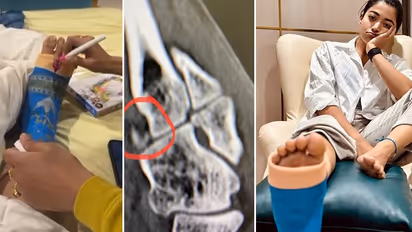 ‘Miss standing on my feet,' says Rashmika Mandanna with 3 fractures and muscle tear, shares X-ray with fans