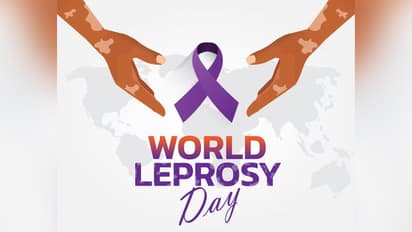 World Leprosy Day 2025 : കുഷ്ഠരോഗം ; അറിയാം രോഗലക്ഷണങ്ങൾ, പ്രതിരോധം
