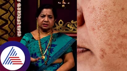 ಮುಖದ ಮೇಲೆ ಬಂಗು ಇದ್ಯಾ? ಒಂದು ತಿಂಗಳು ಹೀಗೆ ಮಾಡಿ ನೋಡಿ: ಖ್ಯಾತ ಆಯುರ್ವೇದ ತಜ್ಞರ ಸಲಹೆ ಕೇಳಿ