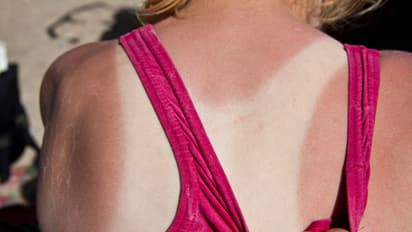 Tan removal tips: easy and affordable home remedies that do wonders for your skin