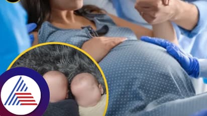 ಅವಳಿ ಮಕ್ಕಳು ಹುಟ್ಟಿದ ಬಳಿಕ ಹೊಲಿಗೆ ಹಾಕುವಾಗ್ಲೇ ಹೊಟ್ಟೆಯಲ್ಲಿತ್ತು ಮತ್ತೊಂದು ಮಗು! ಆಗಿದ್ದೇನು ನೋಡಿ!