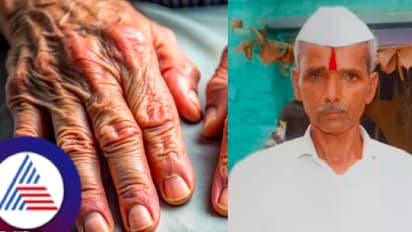 ಮಹಾರಾಷ್ಟ್ರ ಬಳಿಕ ಗುಯಿಲಿನ್-ಬಾರ್ ಸಿಂಡ್ರೋಮ್ಗೆ ಕರ್ನಾಟಕದ ಬೆಳಗಾವಿಯಲ್ಲಿ ಮೊದಲ ಬಲಿ!