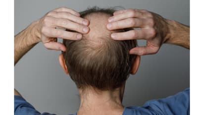 Understanding the Causes of Hair Loss: Expert Insights and Prevention Tips