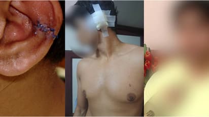 ജൂനിയര്‍ വിദ്യാര്‍ഥികളുടെ ആക്രമണം; ചെവി മുറിഞ്ഞുപോയ വിദ്യാർത്ഥിക്ക് അധ്യാപകര്‍ ചികിത്സ വൈകിപ്പിച്ചെന്ന് പരാതി