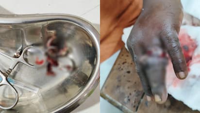 കാലങ്ങളായി ഊരാതിരുന്ന മോതിരങ്ങൾ കുടുങ്ങി നീര് വച്ചു, ബുദ്ധിമുട്ടെന്ന് ഡോക്ടർമാർ; ഒടുവിൽ രക്ഷകരായി ഫയർഫോഴ്സ്