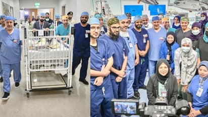 അഞ്ച് ഘട്ടങ്ങളായി 8 മണിക്കൂറോളം നീണ്ട ശസ്ത്രക്രിയ; 17 മാസം പ്രായമുള്ള ഹവ്വക്കും ഖദീജക്കും ഇനി രണ്ടു ജീവിതം