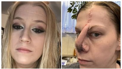 19 മാസത്തിനുള്ളിൽ 70 ലക്ഷം രൂപയുടെ കൊക്കെയ്ന്‍ ഉപയോഗം, ഒടുവില്‍ അവശേഷിച്ചത് മൂക്കിന്‍റെ സ്ഥാനത്ത് ഒരു ദ്വാരം