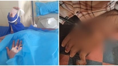 മുള്ളൻപന്നി ആക്രമണം: പ്ലസ് വൺ വിദ്യാർത്ഥിക്ക് പരിക്കേറ്റു, കൈപ്പത്തിയിൽ തറച്ചുകയറിയ മുള്ള് മറുവശത്തെത്തി 