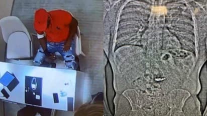 കോടികൾ വിലവരുന്ന വജ്ര കമ്മലുകൾ വിഴുങ്ങി 32കാരൻ, തൊണ്ടിമുതൽ തിരിച്ചെടുക്കാനാവാതെ പൊലീസ്