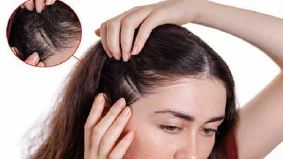 Effects of Amla On Hair