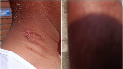 സംസ്ഥാനത്ത് ചൂട് കൂടുന്നു, 3 ജില്ലകളിലായി 3 പേർക്ക് സൂര്യാതപമേറ്റു