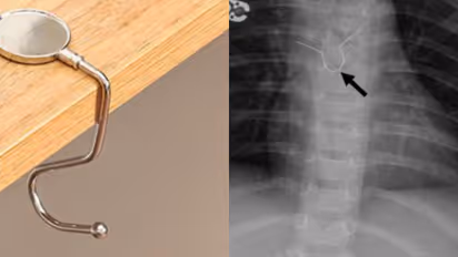 15 വയസുകാരൻ മെഡിക്കൽ കോളേജിലെത്തിയത് തൊണ്ടയിൽ കുടുങ്ങിയ ഹാങ്ങര്‍ ഹുക്കുമായി, ശസ്ത്രക്രിയയിൽ പുറത്തെടുത്തു