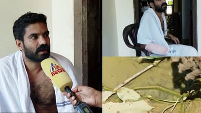 കുളം വൃത്തിയാക്കുന്നതിനിടെ മീൻ കൊത്തി, അണുബാധ ശരീരത്തിലേക്ക്; യുവാവിന്റെ വലത് കൈപ്പത്തി മുറിച്ചുമാറ്റി