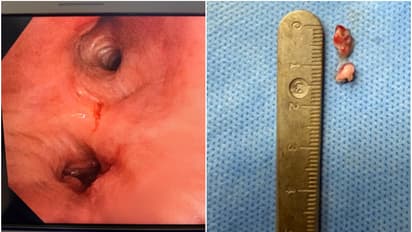 സ്കാനിംഗിൽ ശ്വാസകോശത്തിൽ കണ്ട വളർച്ച ട്യൂമറെന്ന് കരുതി ചികിത്സ, പക്ഷേ അല്ല! ഒരു മീൻമുള്ള്, നീക്കം ചെയ്തു