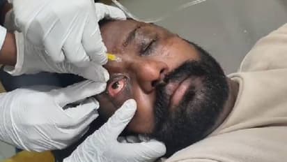  ಬೋಳು ತಲೆಗೆ ಕೂದಲು ಬೆಳೆಸೋಕೆ ಹೋಗಿ 20 ಜನರಿಗೆ ಕಣ್ಣಿನ ಸೋಂಕು!