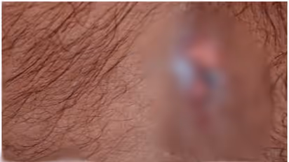 പപ്പടത്തിന്റെ ആകൃതിയിൽ പൊള്ളൽ, തൊലി അടർന്നു; ചെർപ്പുളശ്ശേരിയിൽ ഓട്ടോഡ്രൈവർക്ക് സൂര്യാതപമേറ്റു