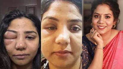 'കണ്ണിനു ചുറ്റും വീക്കം, കണ്ണാടിയിൽ നോക്കാൻ പോലും പേടിയായിരുന്നു'; രോഗാവസ്ഥയെ കുറിച്ച് വീണ