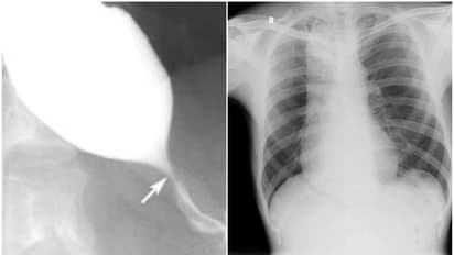 അക്കാലാസിയ കാര്‍ഡിയ, ഭക്ഷണം പോലും കഴിക്കാന്‍ കഴിയാത്ത അവസ്ഥ; ചികിത്സിച്ച് ഭേദമാക്കി കോഴിക്കോട് മെഡിക്കൽ കോളേജ്