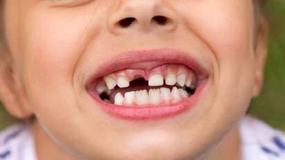 Ways to protect childrens teeth from cavities