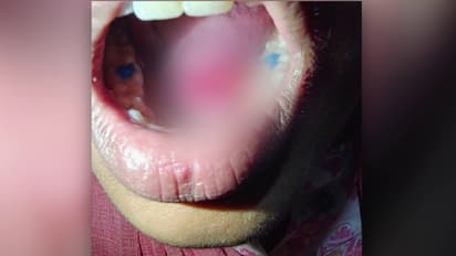 ഡ്രില്ലർ തട്ടി യുവതിയുടെ നാക്കിൽ ഗുരുതര പരുക്ക്; ഡെന്റൽ ക്ലിനിക്കിൽ ചികിത്സക്കിടെ അപകടം; പൊലീസ് കേസെടുത്തു