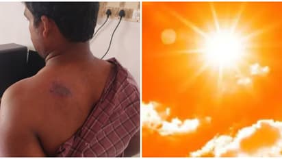 തിരുവനന്തപുരത്ത് ഉച്ചയ്ക്ക് പുറത്തിറങ്ങിയപ്പോൾ സഹകരണ സംഘം ജീവനക്കാരന് സൂര്യാഘാതമേറ്റു; പൊള്ളലേറ്റത് മുതുകിൽ