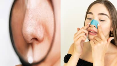 blackheads on the nose