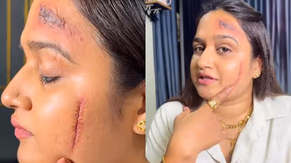 നിമിഷങ്ങൾക്കുള്ളിൽ നെറ്റിയിലും കവിളത്തും മുറിവേറ്റതിന്റെ പാടുകൾ, സിക്ക് ലീവ് കിട്ടാൻ പറ്റിയ മേക്കപ്പ്, വിമർശനം