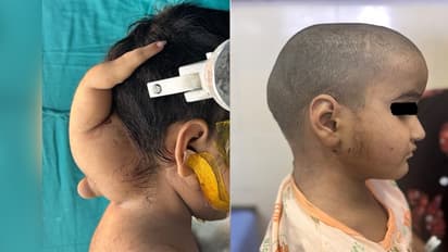 ಏಮ್ಸ್ ವೈದ್ಯರ ಯಶಸ್ವಿ ಶಸ್ತ್ರಚಿಕಿತ್ಸೆ, 3 ವರ್ಷ ಮಗುವಿನ ತಲೆಯಲ್ಲಿದ್ದ ಅವಳಿ ದೇಹದ ಬಾಗ ಸರ್ಜರಿ