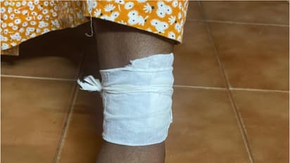 തെരുവുനായയെ കണ്ട് വിരണ്ടോടി, ഒട്ടത്തിനിടെ വീണവര്ക്ക് പരിക്ക്; കൂട്ടത്തില് വീട്ടമ്മയ്ക്ക് കടിയേറ്റു