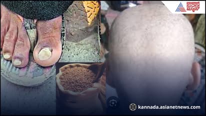 ಸರ್ಕಾರದ ಗೋಧಿ ಎಫೆಕ್ಟ್​? ಹಲವು ಊರುಗಳಲ್ಲಿ ತಲೆಬೋಳು, ಕಳಚುತ್ತಿವೆ ಉಗುರು! ಎಲ್ಲೆಡೆ ಆತಂಕ