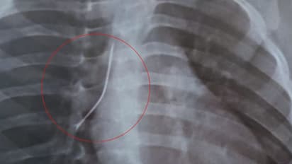 ഒരു വയസുള്ള കുട്ടിയ്ക്ക് ശ്വാസമെടുക്കാൻ കടുത്ത ബുദ്ധിമുട്ട്; ആശുപത്രിയിൽ എക്സ്റേ എടുത്തപ്പോൾ ശ്വാസനാളത്തിൽ പിൻ