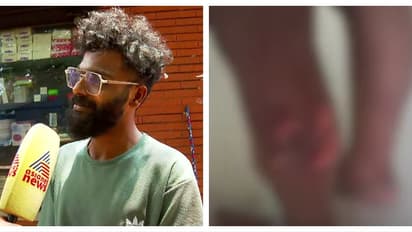 വാക്സിൻ എടുത്തിട്ടും പേവിഷബാധ, തലയ്ക്ക് കടിയേറ്റതാകാം കാരണമെന്ന് ഡോക്ടർമാർ; കുഞ്ഞ് ഗുരുതരാവസ്ഥയിലെന്ന് അച്ഛൻ