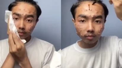 ಹಣ ಉಳಿಸಲು ಸೆಕೆಂಡ್ ಹ್ಯಾಂಡ್ ಬಟ್ಟೆ ಖರೀದಿಸ್ತೀರಾ? ಈ ಯುವಕನ ಚರ್ಮರೋಗ ಕೇಳಿದ್ರೆ ಶಾಕ್!