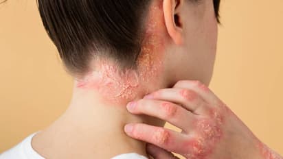 Lupus Day 2025 Symptoms and Causes