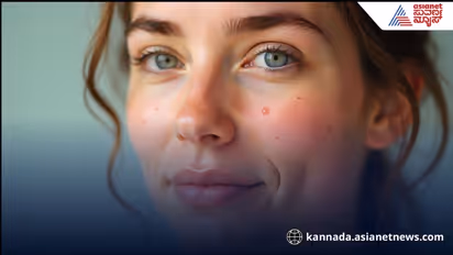 మొటిమలు మన హెల్త్ ఎలా ఉందో చెప్పేస్తాయా?