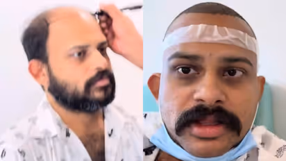 മൊട്ടത്തലയാ, കഷണ്ടി, തുടങ്ങിയ വിളികൾക്ക് അവസാനം; വീഡിയോയുമായി വിജയ് മാധവ്