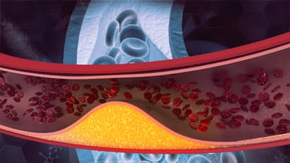 ഉയർന്ന കൊളസ്ട്രോൾ ഉള്ളവർ ഒഴിവാക്കേണ്ട ഒമ്പത് ഭക്ഷണങ്ങള്‍