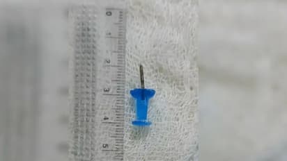 ശ്വാസംമുട്ടും നെഞ്ചുവേദനയും; 5 ദിവസം കുട്ടിയുടെ ശ്വാസകോശത്തിനകത്തിരുന്നത് ബോർഡ് പിൻ, ഗുരുതരമെന്ന് ഡോക്ടർമാർ