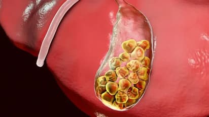 পিত্তথলির সুস্থ রাখতে খাদ্যতালিকায় কী কী রাখবেন? জেনে নিন পুরো ডায়েট